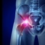 Lawyer Lee W. Davis handles cases of the failure of DePuy Pinnacle and A.S.R. hip implants for people.